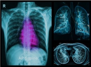 Covidien's superDimension navigation system enables a minimally invasive approach for accessing difficult-to-reach areas of the lung