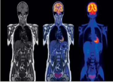 An MRI (left) shows even the smallest changes to tissue and organs, while a PET scan (right) shows the activity in specific parts of body. A combined molecular MR image (center) gives additional information for a more comprehensive assessment of the disea